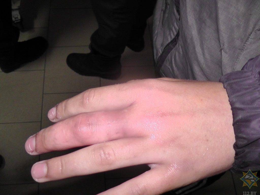 Видеофакт: спасатели в Светлогорске освободили парня от кольца на пальце
